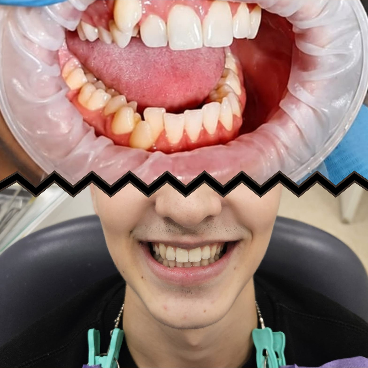 Tak wygląda efekt po 1,5 roku leczenia w Dental Clinica